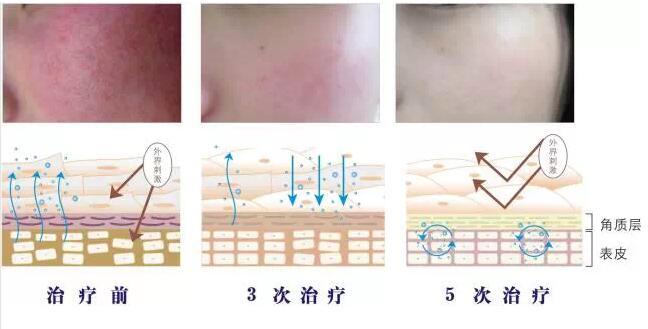 舒敏之星,临床对比图